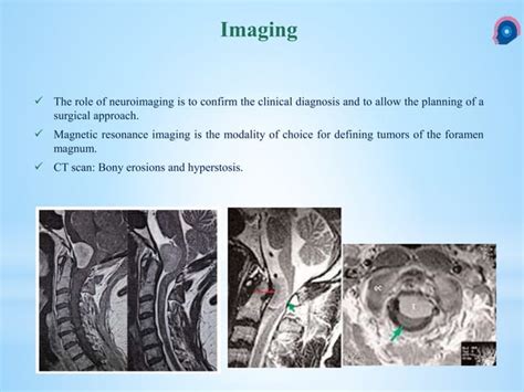 Foramen Magnum Meningioma | PPT | Free Download