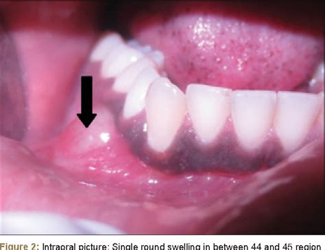 Odontogenic Keratocyst Clinical Features