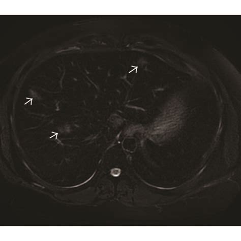 A B Baseline Mri A Axial T2 Weighted Fat Saturated T2w Fs Image Download Scientific