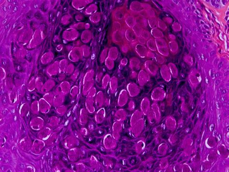 Molluscum Contagiosum Molluscipoxvirus The Clinical Advisor