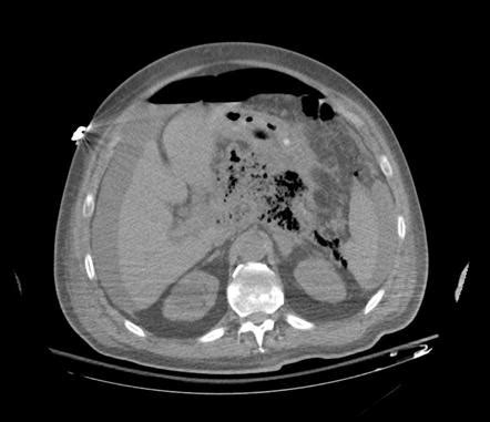 Necrotizing Pancreatitis Radiology Case Radiopaedia Org