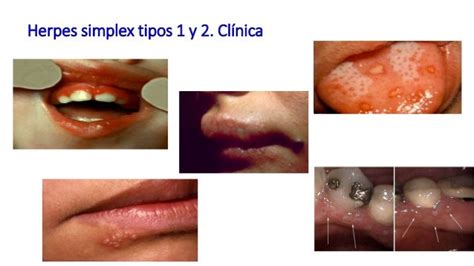 Infecciones De Transmisión Sexual Herpes Y Gonorrea