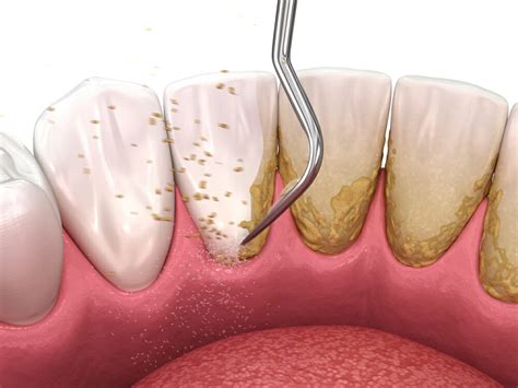 Scaling And Root Planing For Gum Disease Periodontal Therapy