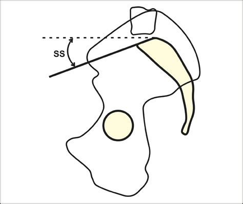 Scielo Brasil Spinopelvic Sagittal Balance What Does The Radiologist Need To Know