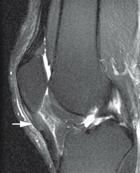 Tendinite Patelar Dr Oliver Ulson Traumatologia Ortopedica