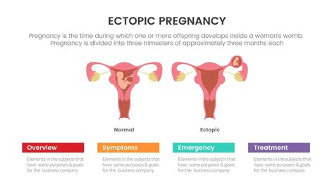 Ectopic Pregnant Or Pregnancy Infographic Concept For Slide