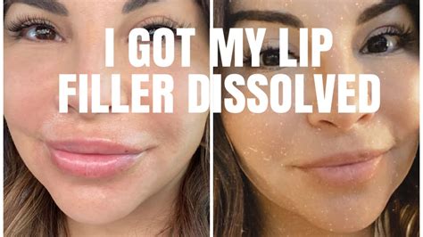 I Got My Lip Filler Dissolved Youtube