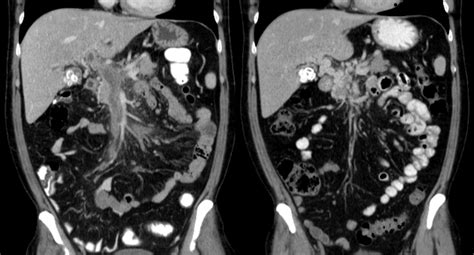 Portal vein thrombosis overview - wikidoc