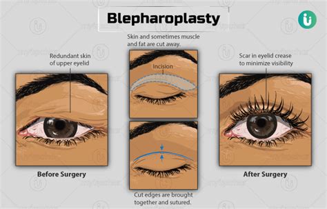 Blepharoplasty Procedure Purpose Results Cost Price