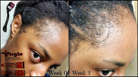 Regrow Edges Challenge Derma Roller Virgin Hair Fertilizer Week 2