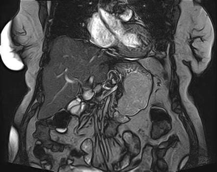 Gastrointestinal Stromal Tumor Gist Stomach Radiology Case