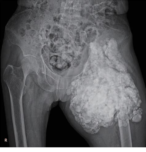 Figure 1 From Pathologic Fracture Of Femoral Neck In A Patient With