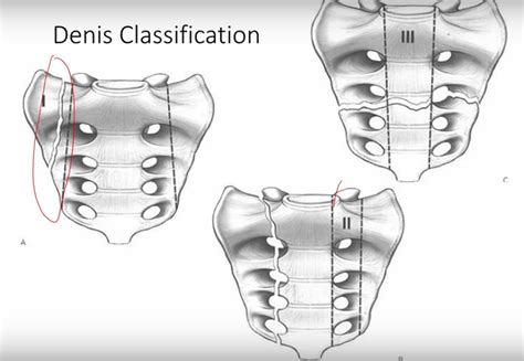 Sacral Fractures Classifications And Indications —