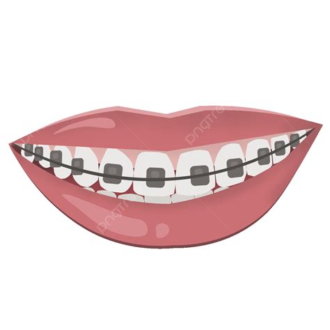 Teeth With Braces Clipart