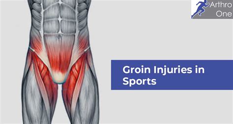 Groin Injuries in Sports – Arthro One