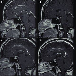 MR T1 Weighted Imaging With Gadolinium Enhancement A A Well Enhanced