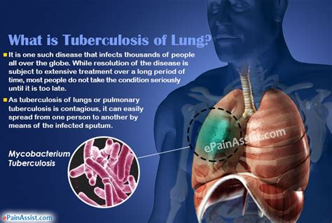 Tuberculosis Of Lung Or Pulmonary Tuberculosis Causes Symptoms Types