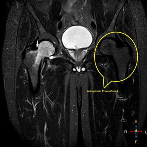 Osteoporosis X-ray - wikidoc