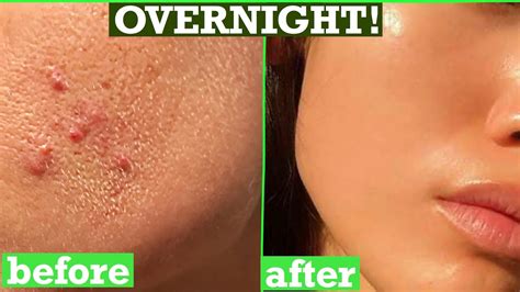 How To Get Rid Of Acne Pimples Tiny Bumps On Face Overnight Simple Home Remedy Diy