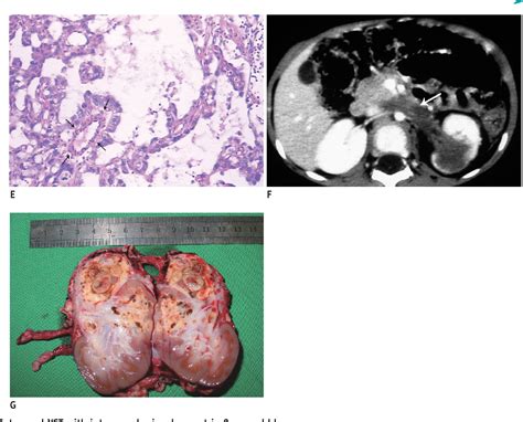 Figure 1 From Ct Findings Of Intrarenal Yolk Sac Tumor With Tumor