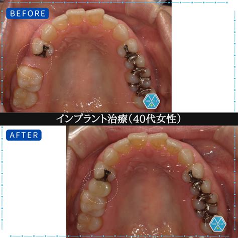 症例のご紹介5：インプラント治療《40代女性》 埼玉県川越市のインプラント治療ガイド