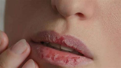 Consejos Para Combatir Los Labios Agrietados O Secos FarmaLink Pe