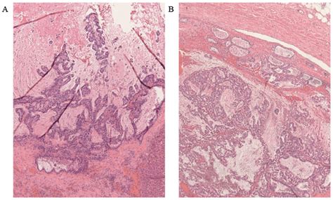 Microscopic Findings Of The Liver Metastatic Lesion Hematoxylin And