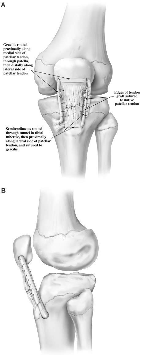 Patellar Tendon Rupture