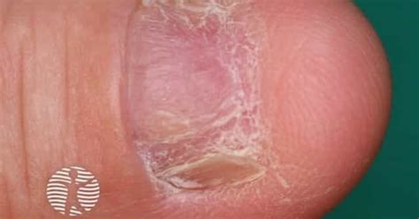 Dermnet Nail Dystrophy Due To Lichen Planus Image