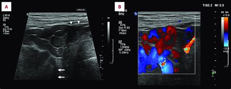 Grayscale Ultrasound And Color Doppler Ultrasound Imaging Of The Right