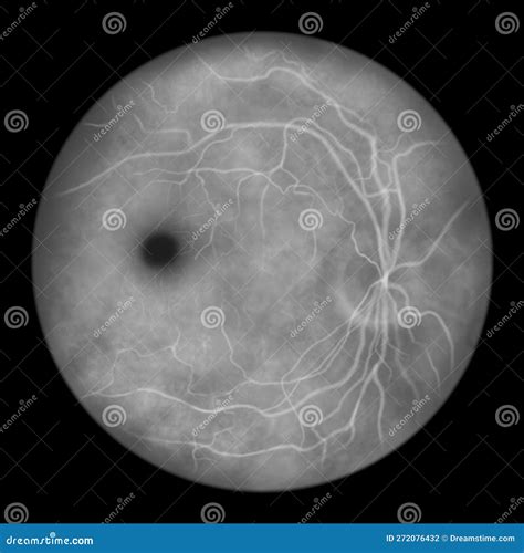 Best Vitelliform Macular Dystrophy, Vitelliform Stage, Classic Egg-yolk ...