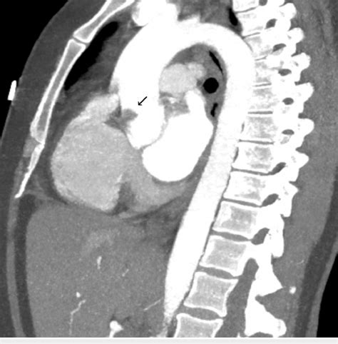 Computerized Tomography Of Chest With Angiography Showing Filling