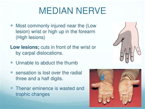 Paralysis Of Median Nerve