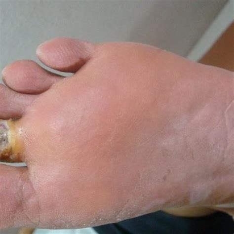 Showing an ulcer over left 2 nd toe. It is infected. Hence it is class ...