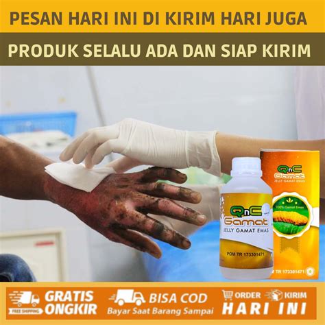 Jual Salep Obat Luka Bakar Kena Air Atau Minyak Panas Dan Keloid Obat