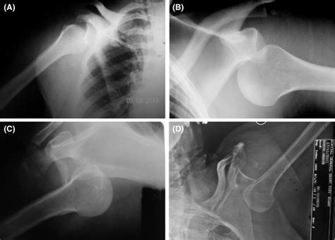 Anteroposterior AP View Radiographs Of Shoulders Demonstrated