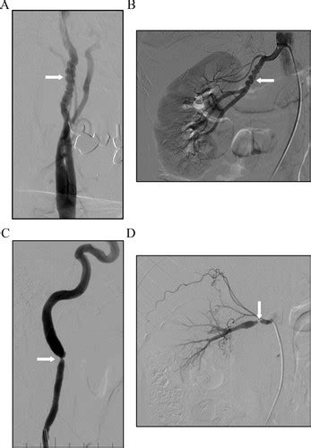 Fibromuscular Dysplasia Circulation