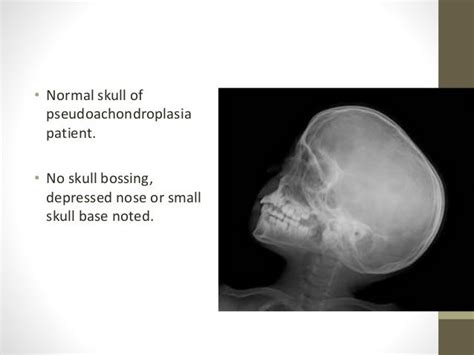 Achondroplasia Pseudochondroplasia And Hypochondroplasia