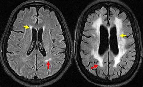 Study Links Left Ventricular Hypertrophy To Deep White Matter