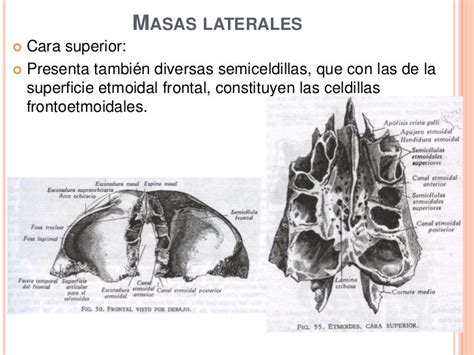 Etmoides