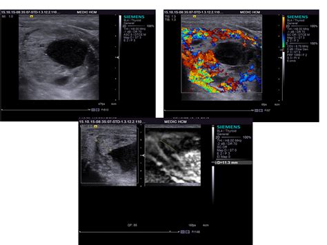 VIETNAMESE MEDIC ULTRASOUND: CASE 341: THYROID TOXIC ADENOMA, Dr LÊ TỰ ...