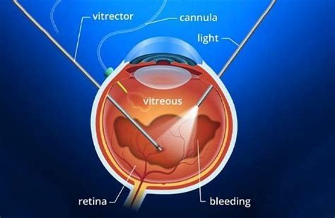 Post-vitrectomy: How Long Does the Gas Bubble Stick Around? – Eye ...