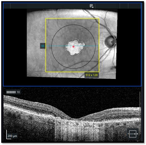 Geographic atrophy as detected by structural en face optical coherence ...