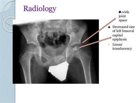 Legg Calve Perthes Disease