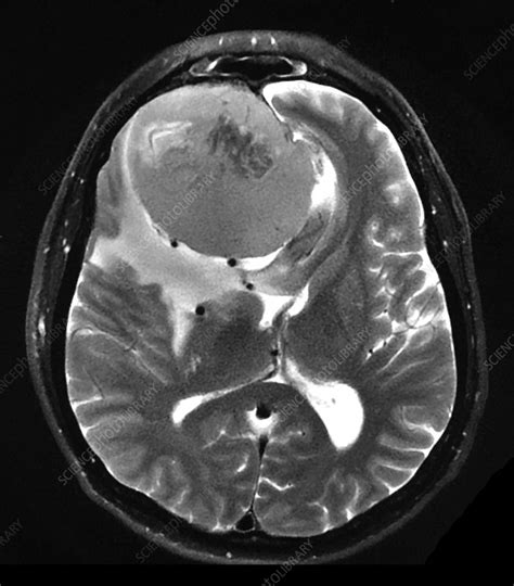 Large Frontal Meningioma Mri Stock Image C Science Photo