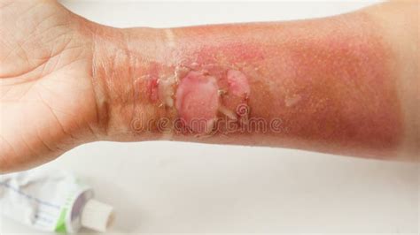 Close Up Of The Painful Peeling Skin Of A Woman`s Hand After A Thermal