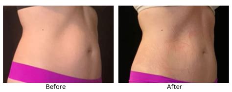 Trusculpt Before And After Results Fat Reduction And Muscle Sculpting