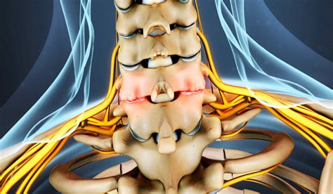 Artrosis o espondilosis cervical Neurocirugía de la Torre