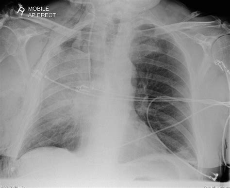 Chest Radiograph Performed 48 H Postoperatively There Has Been An