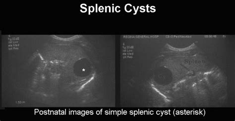 Fetal Splenic Cysts